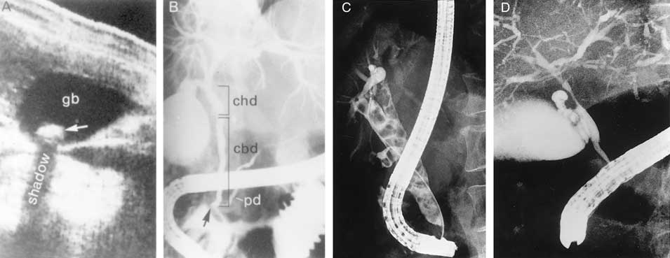 common bile duct stone. common bile duct