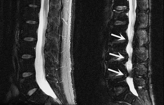 How long does a lumbar myelogram procedure typically last?